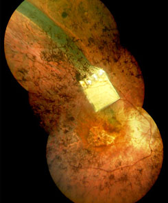 Forrás: Implant AG Forrás: Implant AG